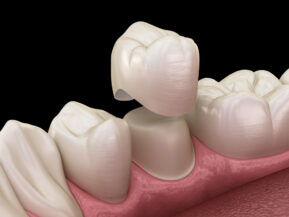 Faceta de Porcelana Dental. Dentes Anteriores