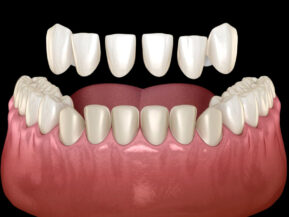 Lente de Contato Dentário e Faceta de Porcelana em Botucatu 5