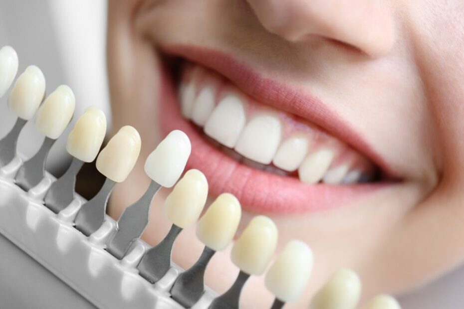 O que são Lentes de Contato Dental, quais as diferenças entre as feitas antigamente e as atuais? 1