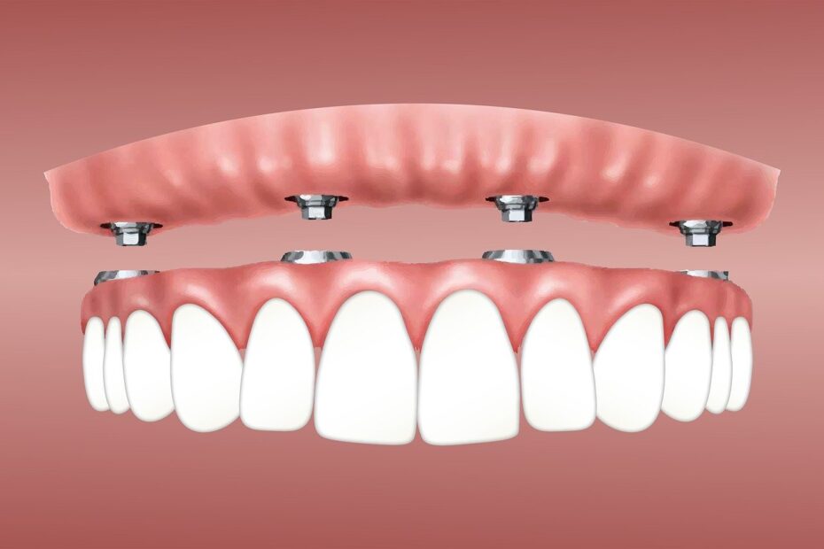 Implante Dentário O que é?