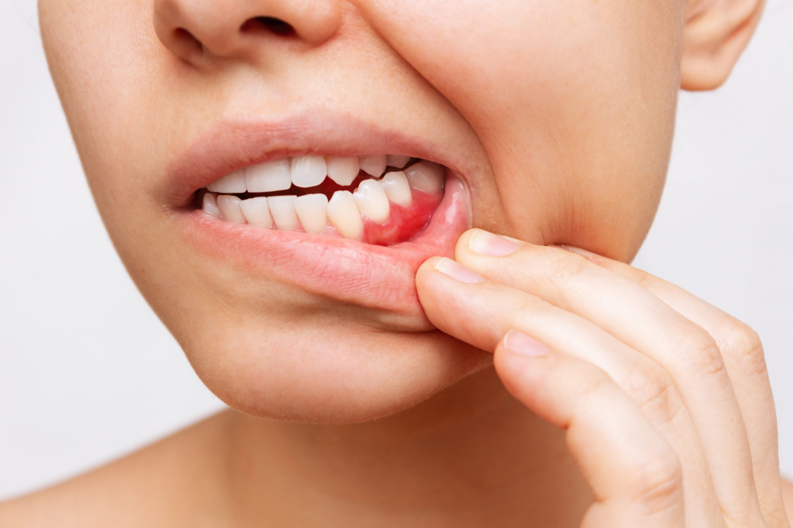 Genviva inflamada pode ser sinal de periodontite